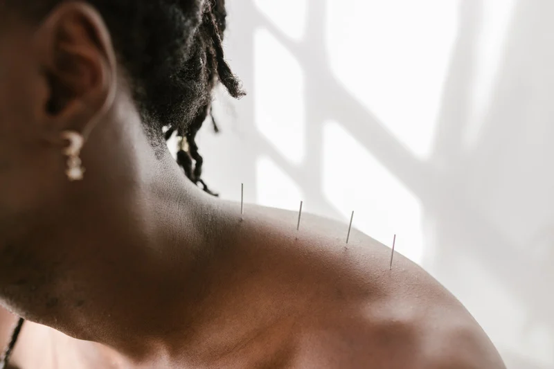 Acupuncture Burnaby BC